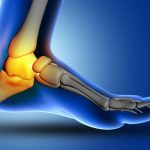 Heel Pain After Running & Its Treatments
