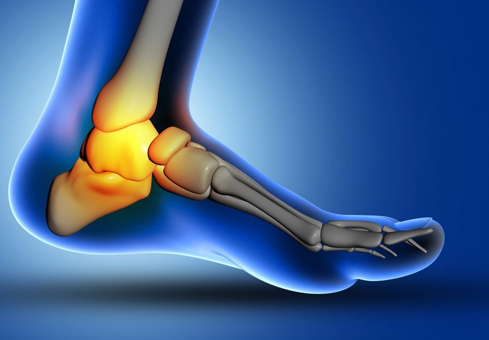 Heel Pain After Running & Its Treatments