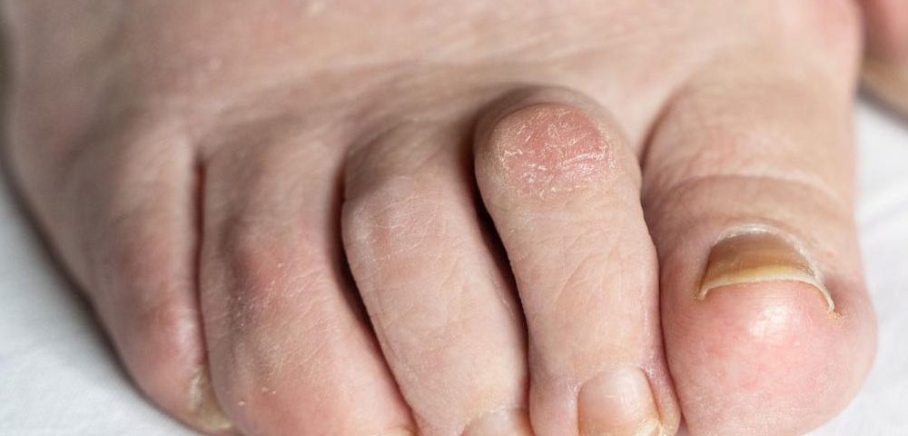 How Long Before You Can Walk After Hammertoe Surgery