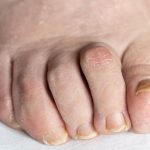 How Long Before You Can Walk After Hammertoe Surgery