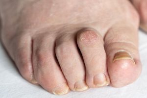 How Long Before You Can Walk After Hammertoe Surgery