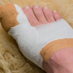 How Long to Keep Bandage on After Ingrown Toenail Removal