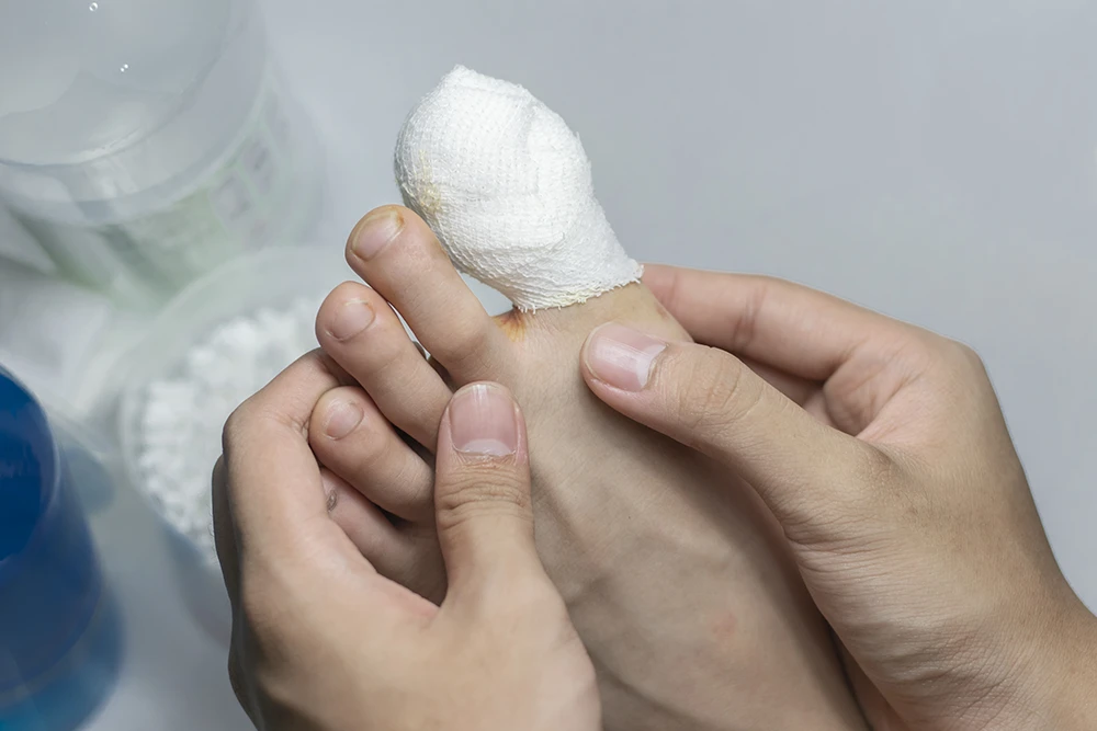 How to Bandage an Ingrown Toenail?