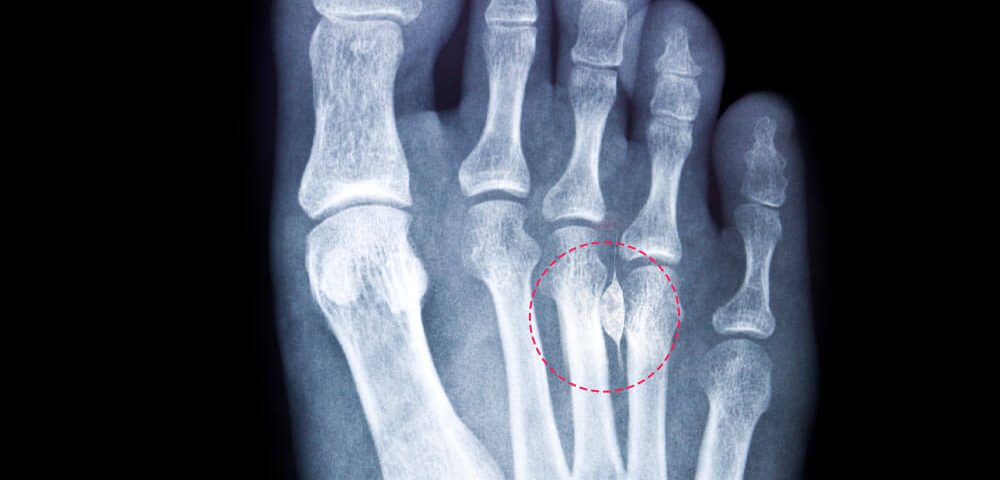 How to Diagnose Morton's Neuroma
