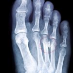 How to Diagnose Morton's Neuroma
