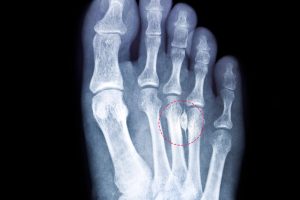 How to Diagnose Morton's Neuroma