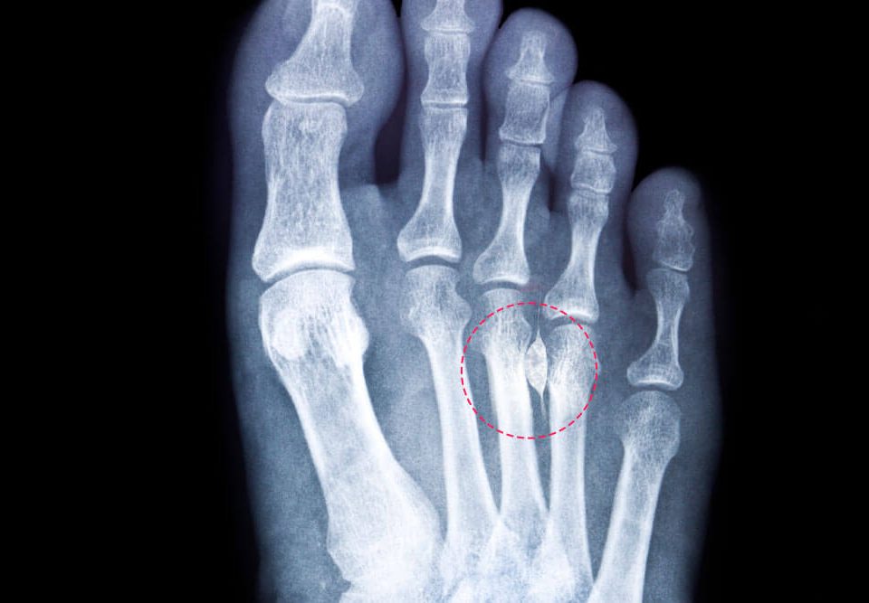 How to Diagnose Morton's Neuroma