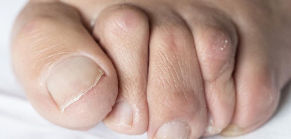 How to Prevent Bunions from Getting Worse