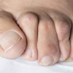 How to Prevent Bunions from Getting Worse