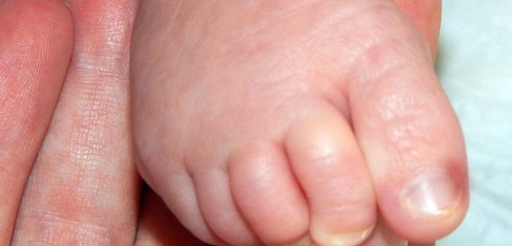 Pediatric Ingrown Toenails in Arizona