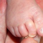 Pediatric Ingrown Toenails in Arizona