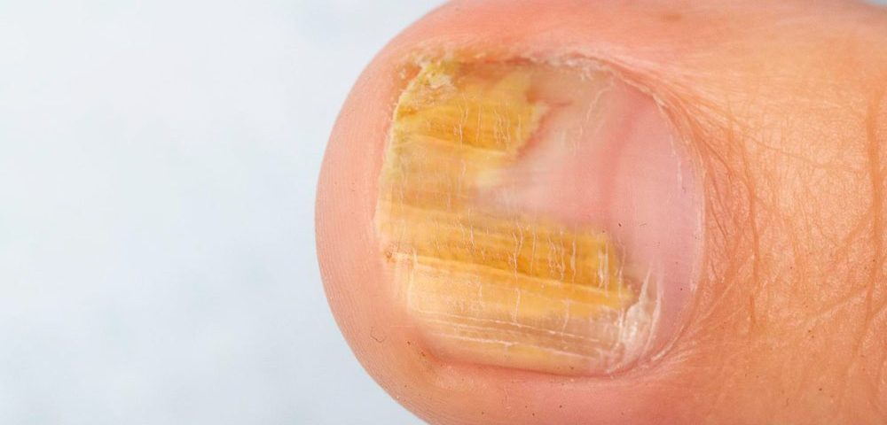 Can Peroxide Kill Nail Fungus