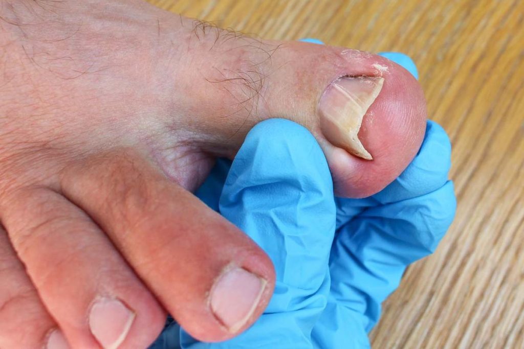 Ingrown Toenail Removal Near Me in Arizona