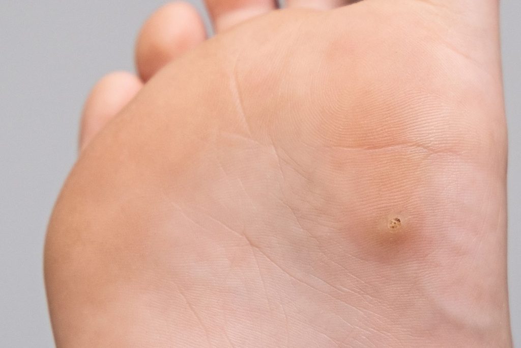 Plantar Warts Treatment Near Me in Arizona
