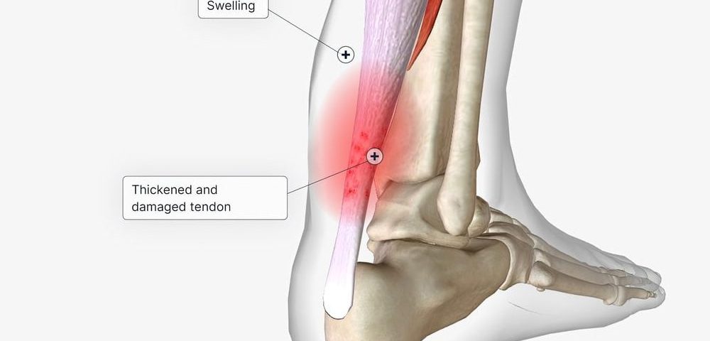 TendoNova Treatment and Ocelot Device What Are They