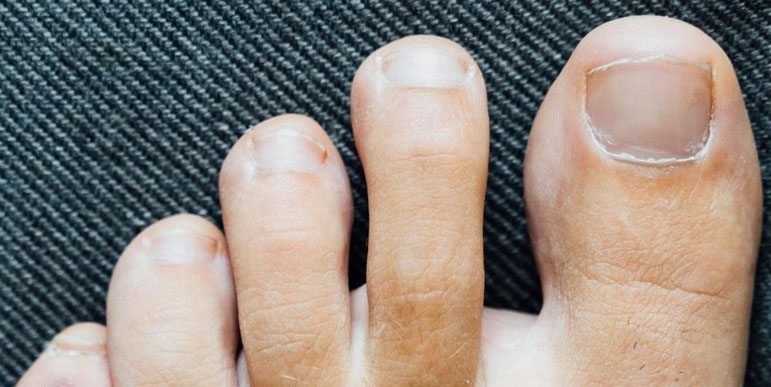 Advanced Ingrown Toenail Removal