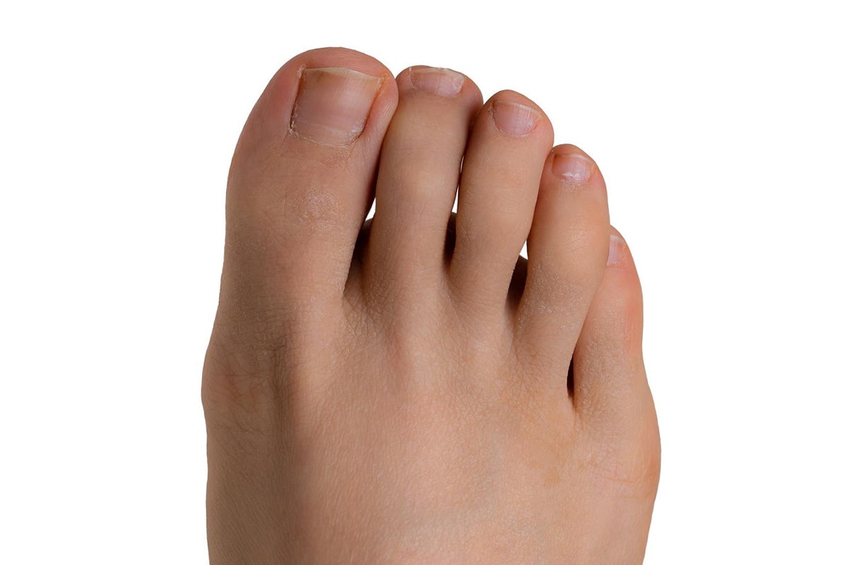 Bunion After