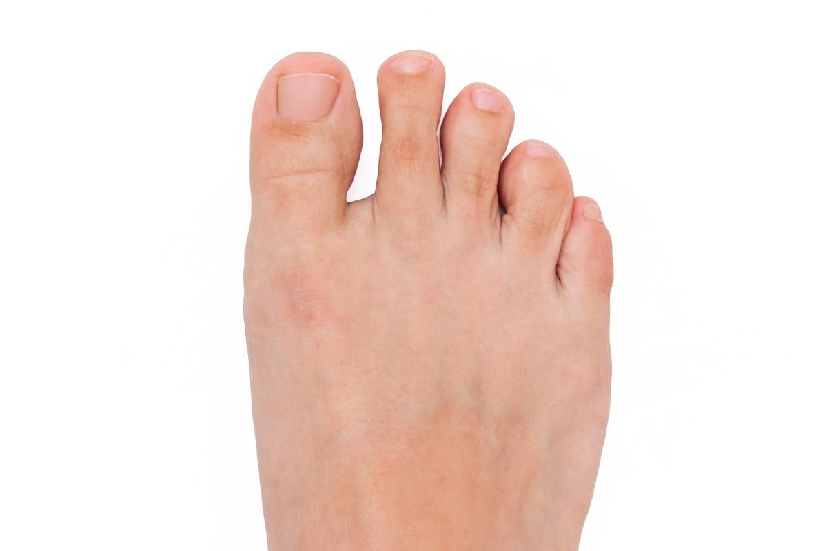 Bunion After