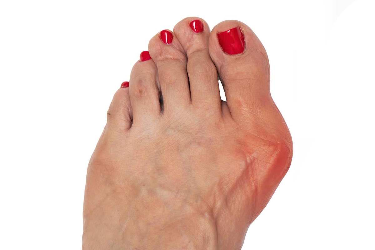 Bunion Before