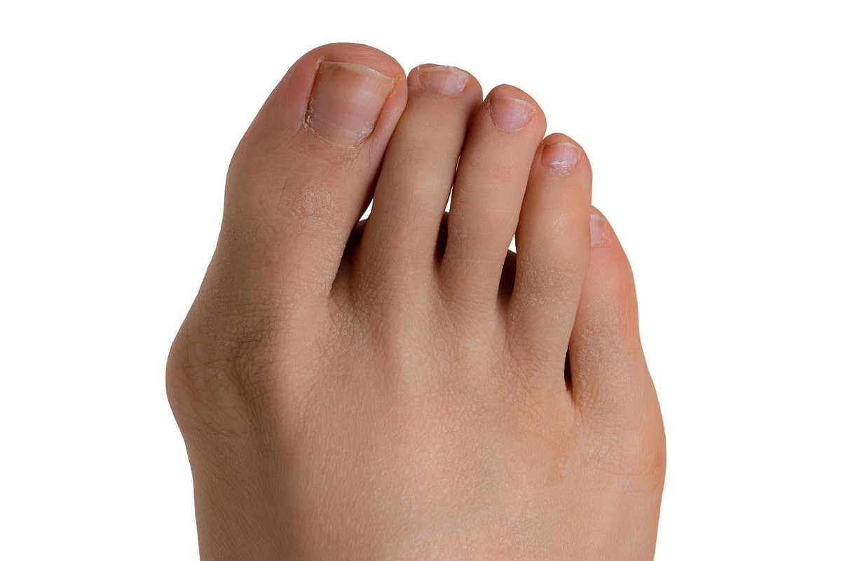 Bunion Before