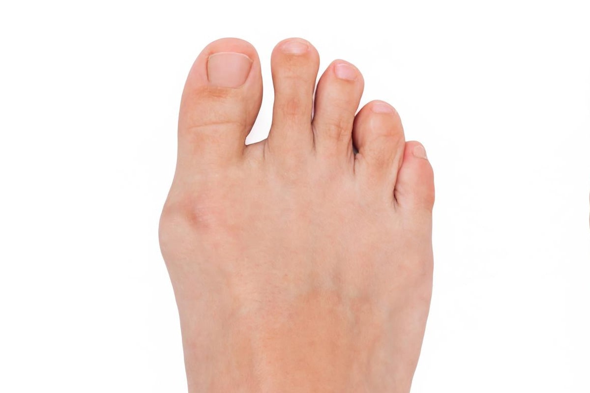 Bunion Before
