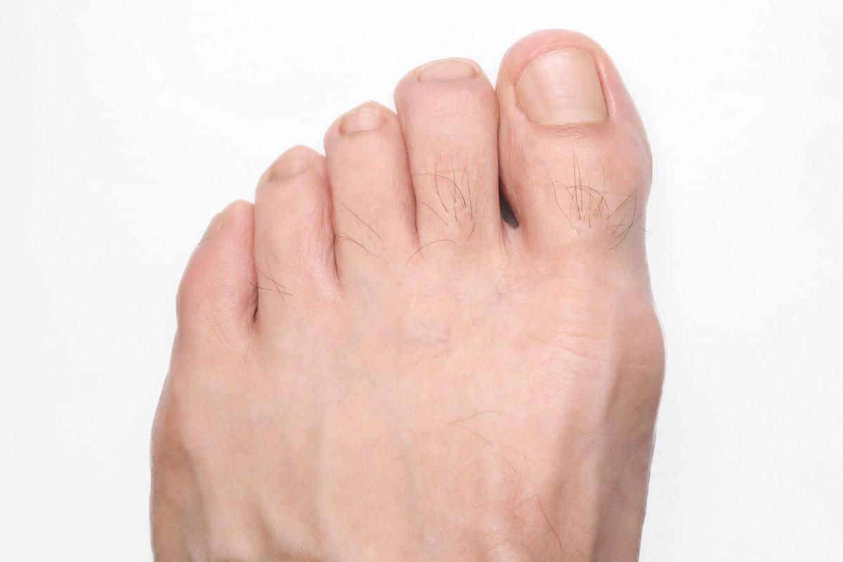 Diabetic Foot Gallery - After