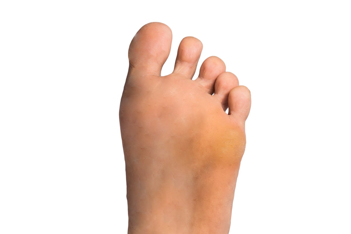 Diabetic Foot Gallery - After