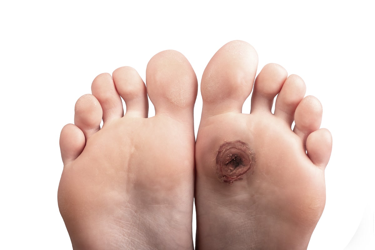 Diabetic Foot Gallery - Before