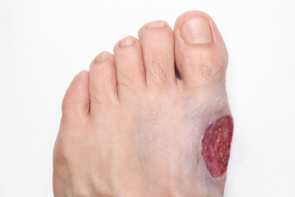 Diabetic Foot Gallery - Before