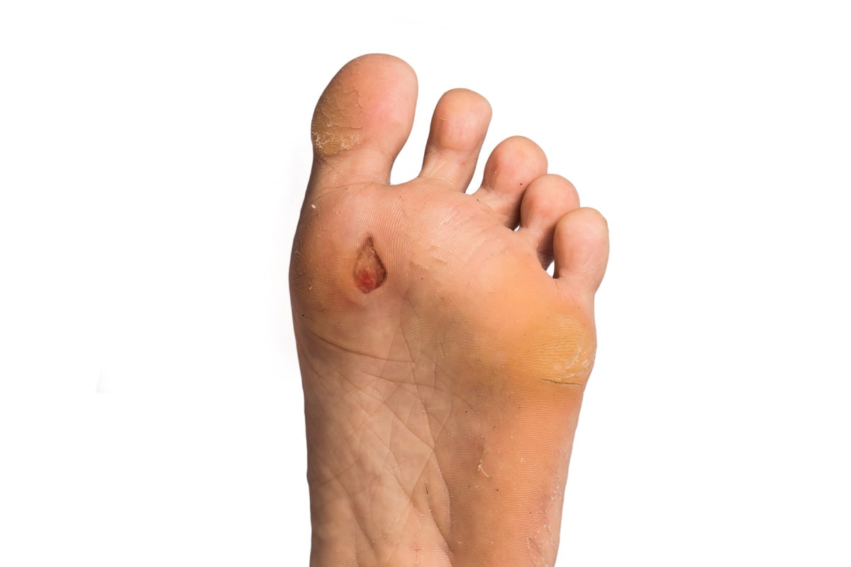 Diabetic Foot Gallery - Before