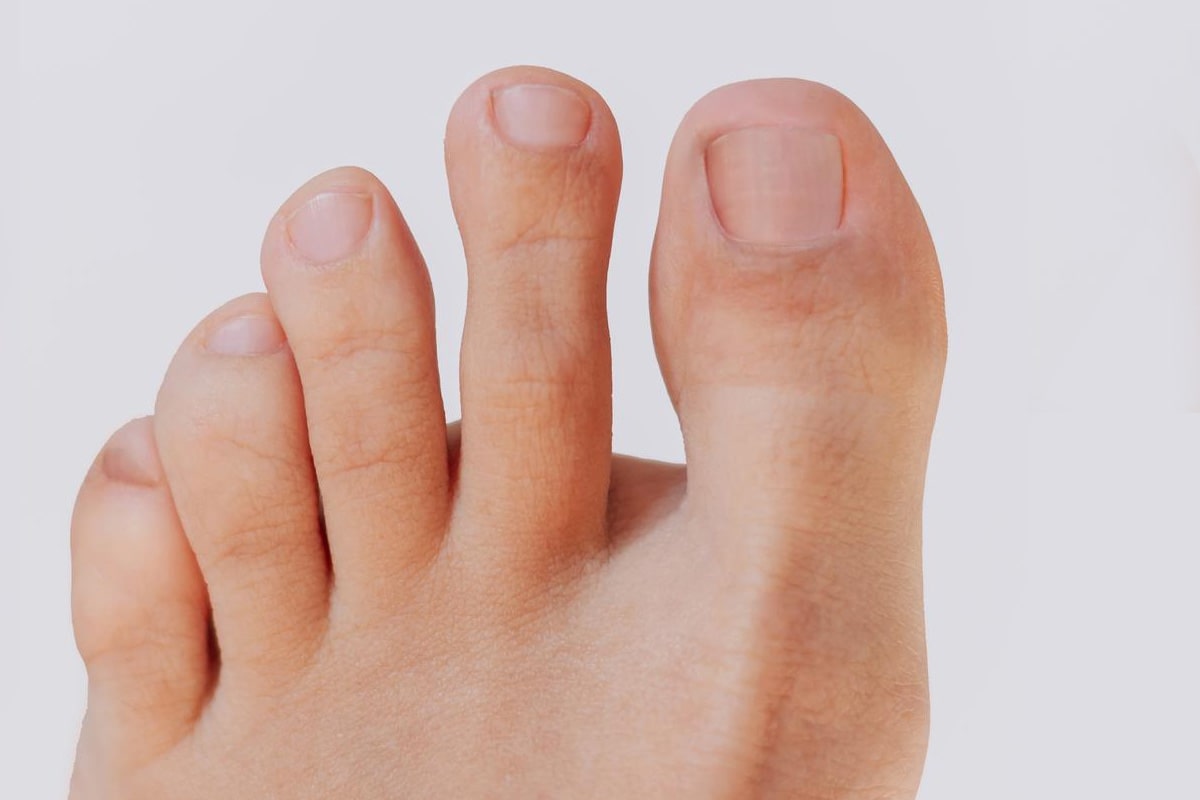 Ingrown Toenail Gallery - After