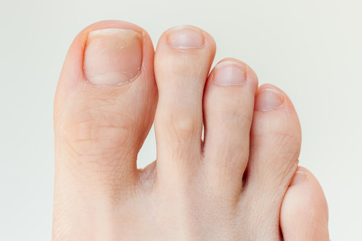 Ingrown Toenail Gallery - After
