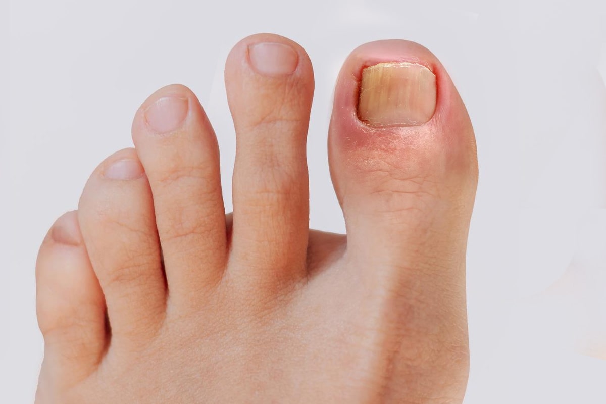 Ingrown Toenail Gallery - Before