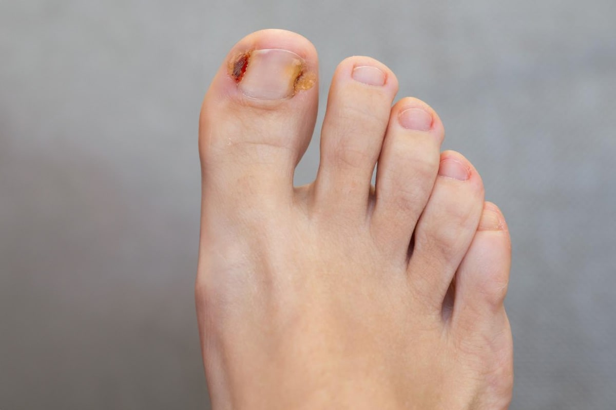 Ingrown Toenail Gallery - Before