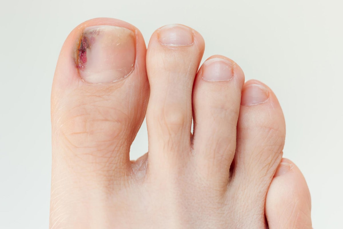 Ingrown Toenail Gallery - Before
