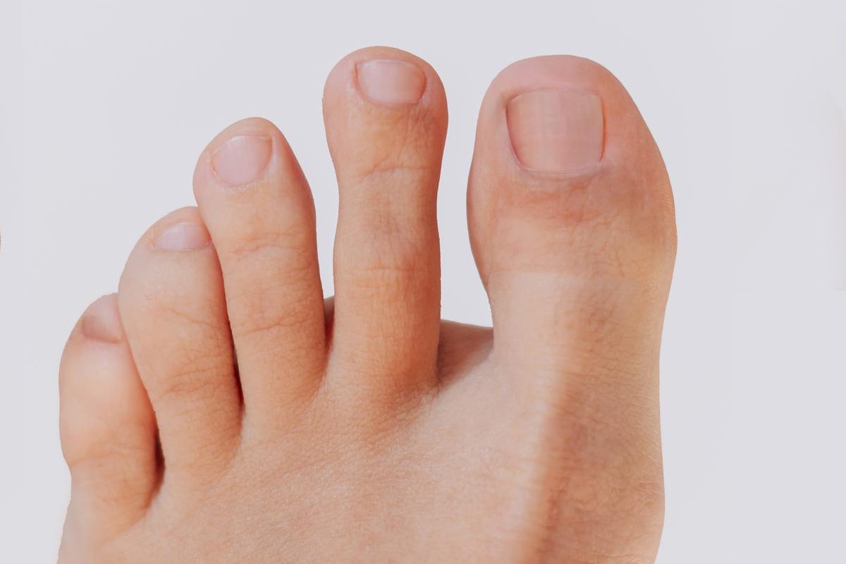 Nail Fungus Gallery - After