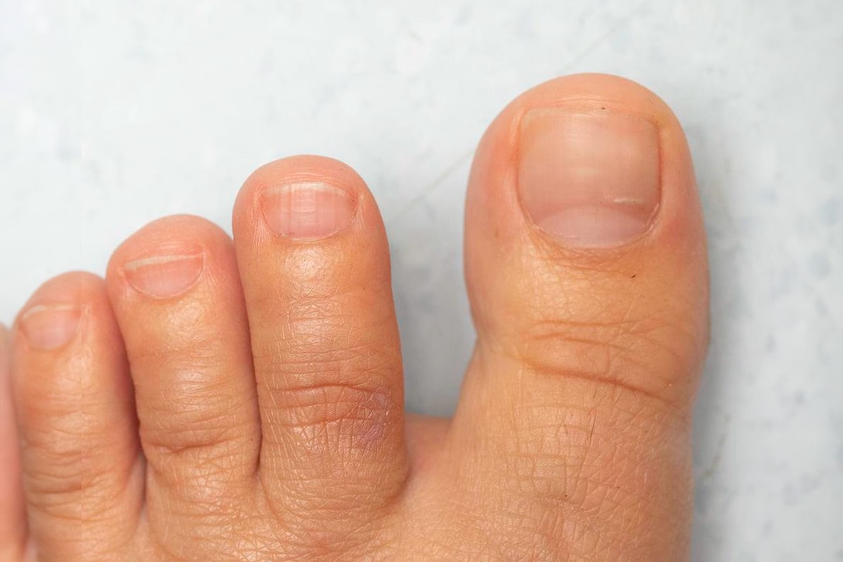 Nail Fungus Gallery - After