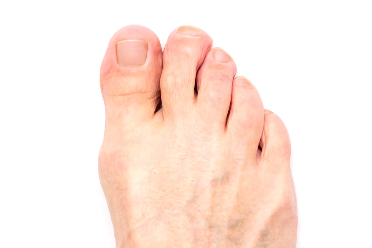 Nail Fungus Gallery - After