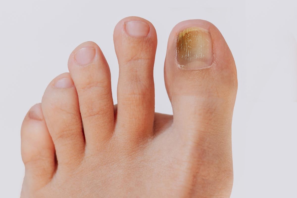 Nail Fungus Gallery - Before