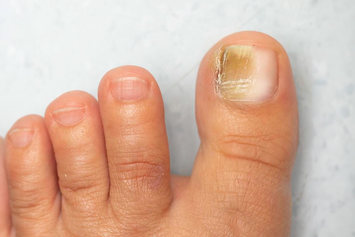 Nail Fungus Gallery - Before