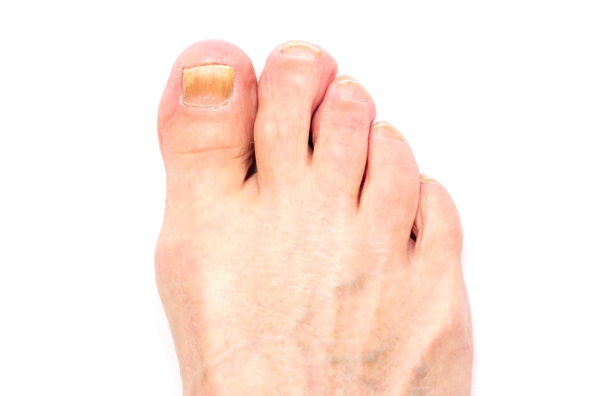 Nail Fungus Gallery - Before