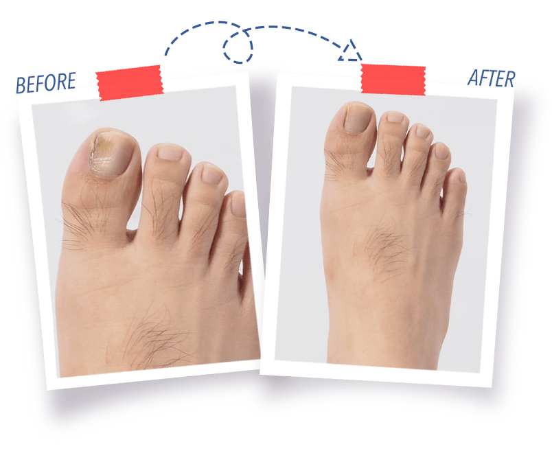 Nail Fungus Landing Slider