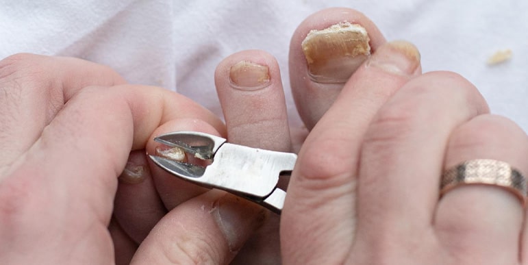 Quick Relief for Painful Ingrown Toenails