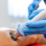 Shock Wave Treatment for Plantar Fasciitis
