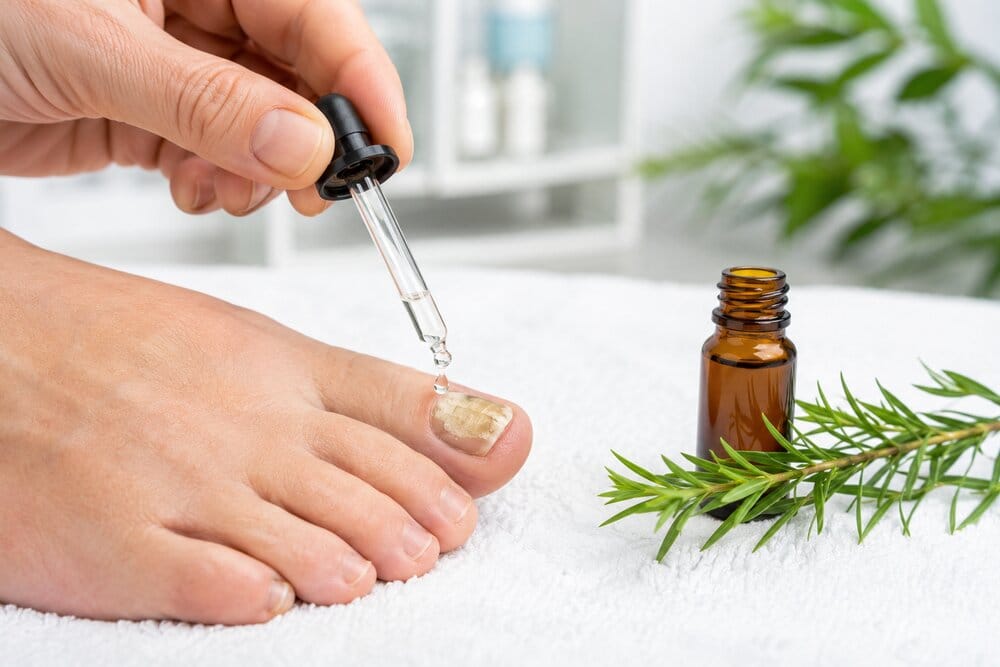 Tea Tree Oil for Nail Fungus
