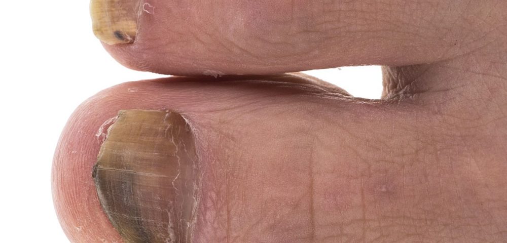 What Kills Toenail Fungus Instantly?