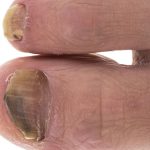 What Kills Toenail Fungus Instantly?