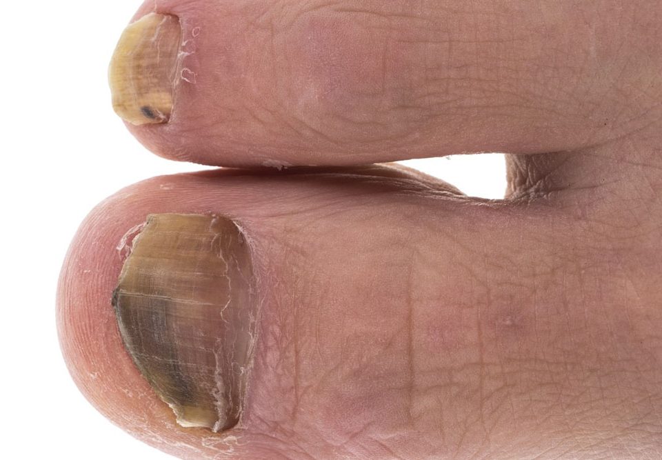 What Kills Toenail Fungus Instantly?
