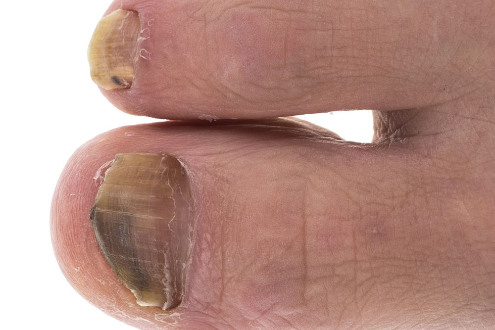 Does Bleach Kill Nail Fungus? Alternative Treatments Footankleaz