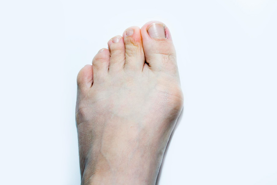 Why Choose Our Bunion Treatments?